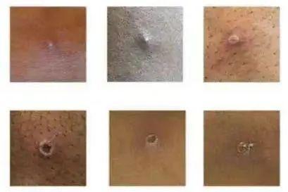 新冠未平猴痘又起!多国爆发猴痘疫情,这些问题要知道